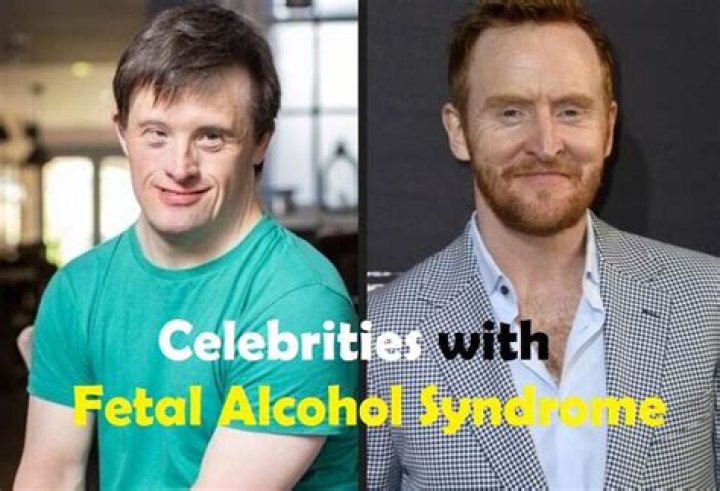 20 Celebrities Born with Fetal Alcohol Syndrome