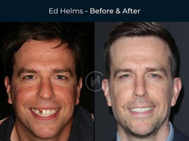 26 Celebrity Dental Implants and Veneers Before and After Photos