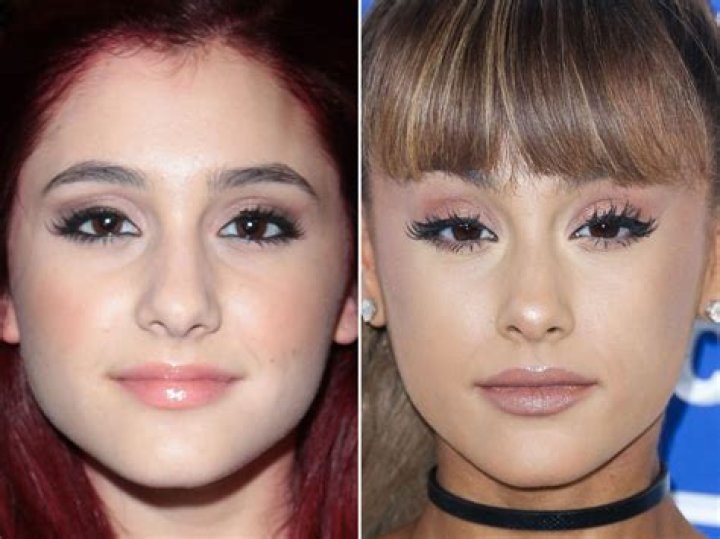 Ariana Grande Before & After The Power of Plastic Surgery! DemotiX