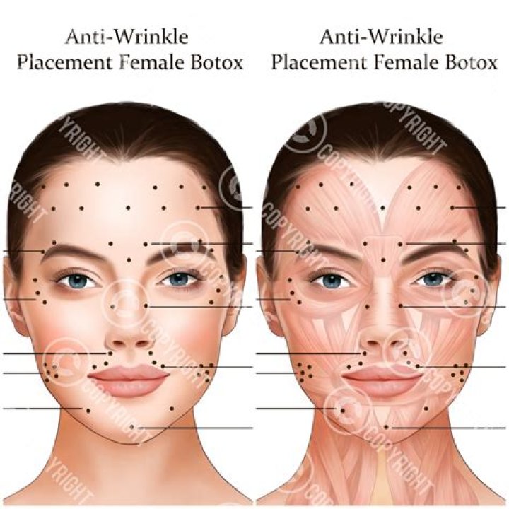 Arriba el Botox! Lyn May a las mujeres hacerse arreglos
