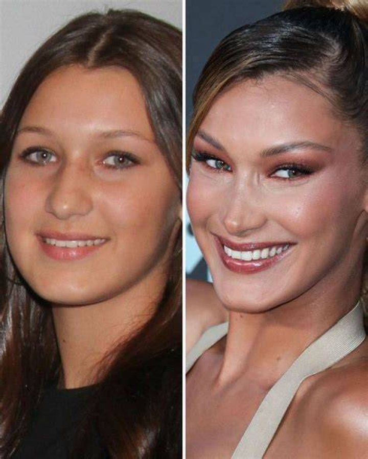 Bella Hadid Before Surgery What Else Do Plastic Surgeons Think She&rsquo;s