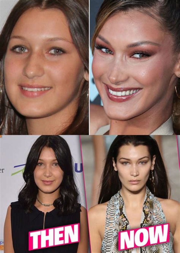 Bella Hadid plastic surgery Bella Before & After Surgery