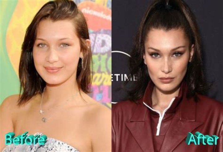 Bella Hadid Plastic Surgery The Supermodel Discussed Whether she's