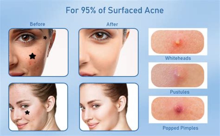 Buy Valleylux Star Face Pimple Patches, 96 Patches Cute Pimple Patches