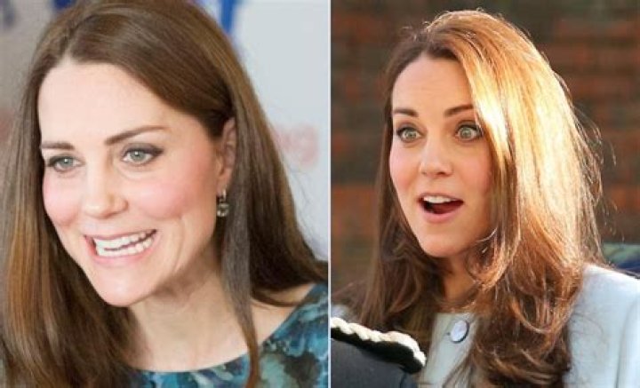 Celebrities With Underbites