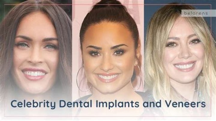Celebrity Dental Implants and Veneers Before and After Photos
