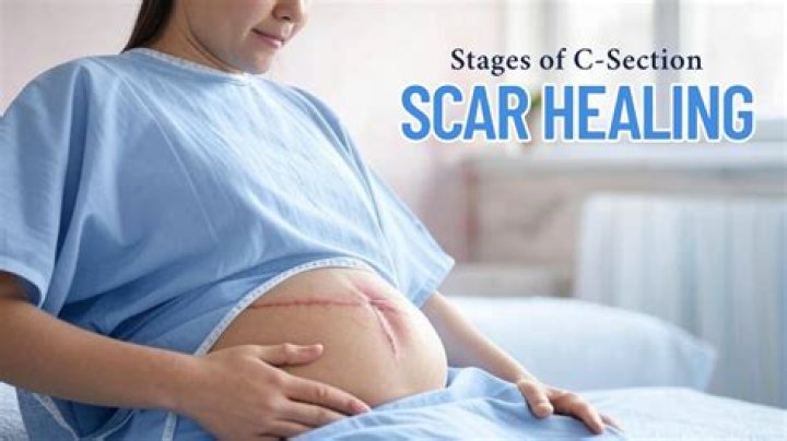 Csection Scar Smells Why It Happens and What To Do