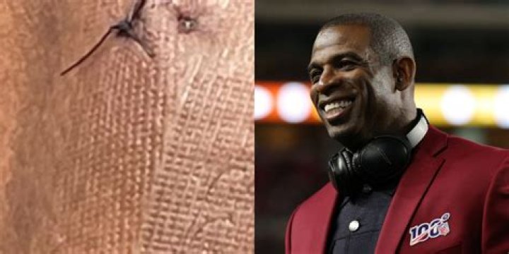 Deion Sanders Shares Gruesome Photo Of His Foot After Surgery (PIC)