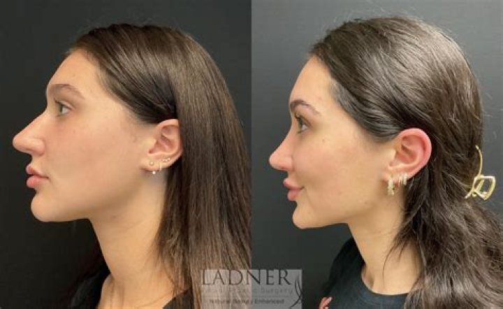 Did Rick Ness Get A Nose Job? Expert Analysis Of Rhinoplasty Rumors