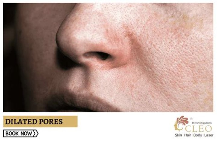 Dilated pore Stock Image C028/4430 Science Photo Library