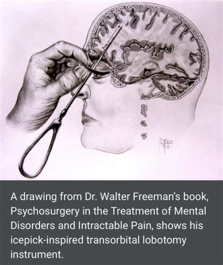 Do you need a lobotomy? Lobotomy Before and After pics CVLT Nation