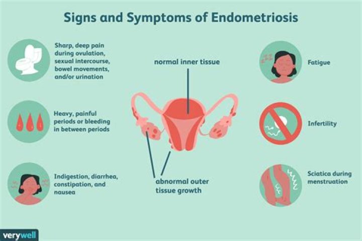 Endometriosis Pain Location 11 Natural Treatments For Endometriosis