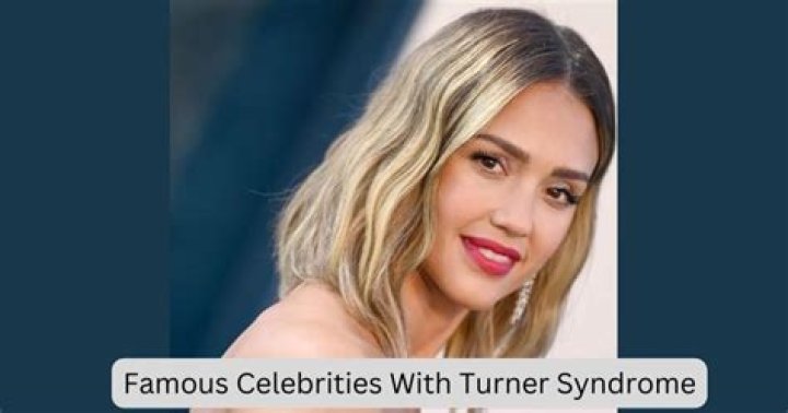 Famous Women With Turner Syndrome