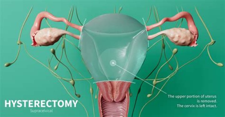 Fibroids Don&rsquo;t Mean a Hysterectomy Dr Burt Webb GYN YouTube