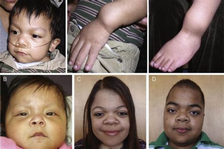 Figure 1,2 from Perlman syndrome (renal hamartomas, nephroblastomatosis