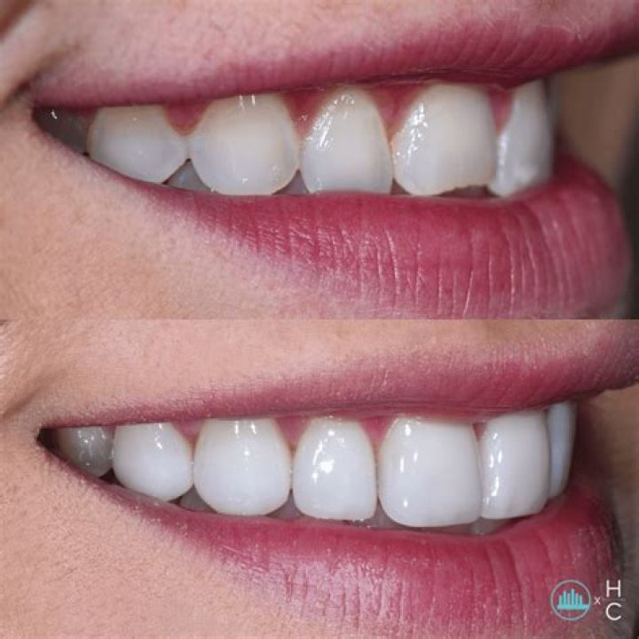 Full Mouth Reconstruction Davidsville & Johnstown, PA Dr. Ernest Mantini