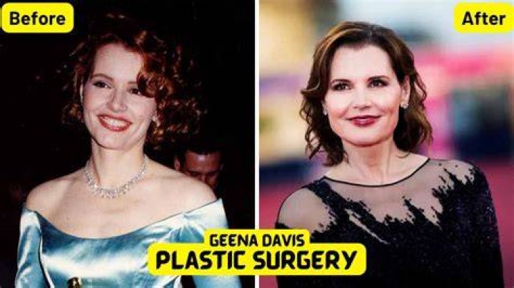 Geena Davis plastic surgery (6) Celebrity plastic surgery online