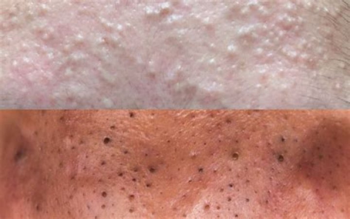 Gigantic Blackheads Dilated Pore of Winer Explained! The Pretty Pimple