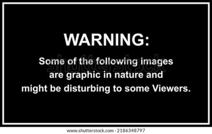 GRAPHIC IMAGE WARNING Doctors find 26pound tumor inside pregnant