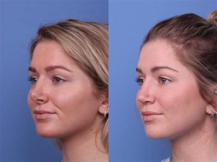 Harry Connick Plastic Surgery Before and After Facelift and Botox