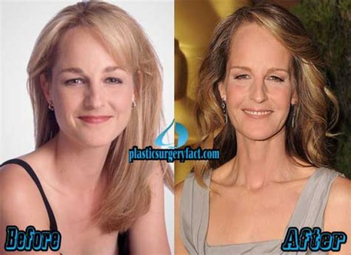 Helen Hunt Plastic Surgery Before & After Pictures Plastic Surgery Log