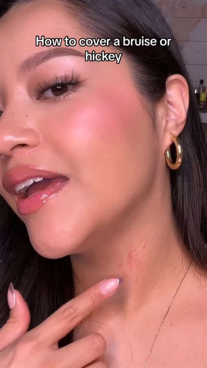 How To Lessen A Hickey Baseballprince20