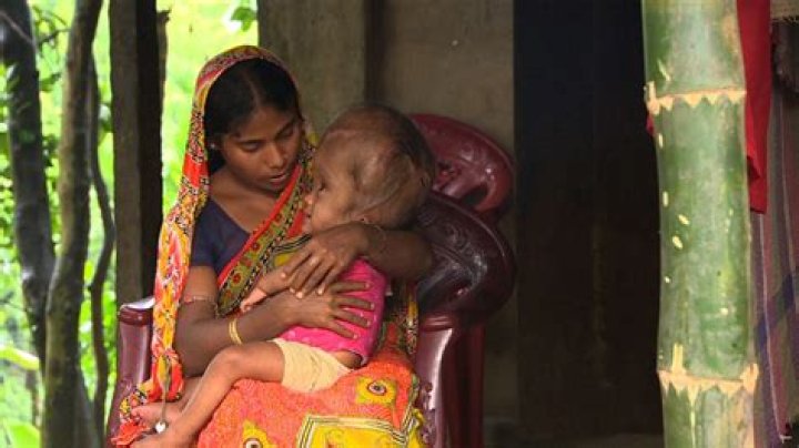 Indian child Roona Begum recovering after hydrocephalus surgery CNN