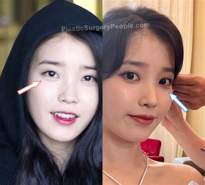 IU Plastic Surgery Before and After Photos Latest Plastic Surgery