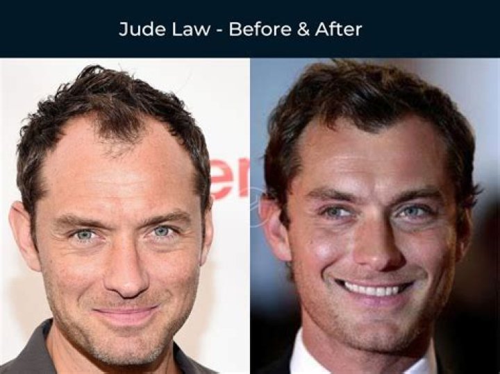 Jude Law Hair Transplant Before After