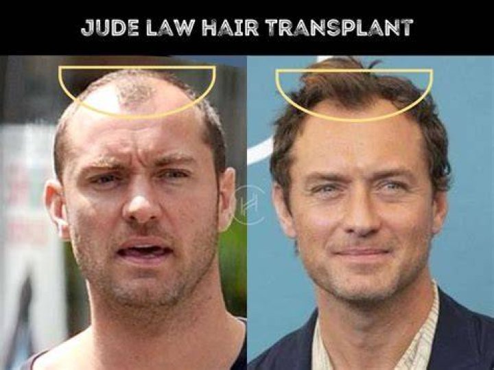 Jude Law Hair Transplant Hair Loss & Technical Analysis