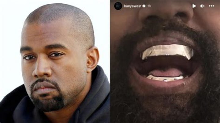 Kanye West gets 850K titanium dentures modeled after James Bond spy
