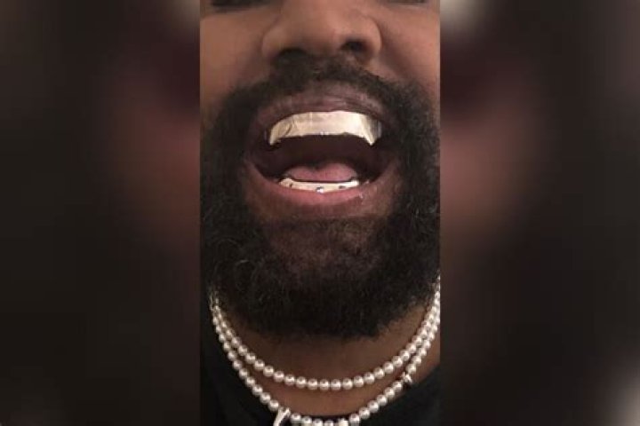 Kanye West replaced his teeth with 850k James Bondinspired Titanium