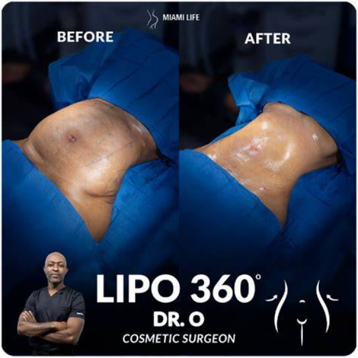Liposuction in Southwest Florida Cosmetic and Plastic Surgery Baroudi