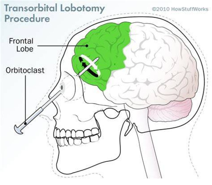 Lobotomy Procedure