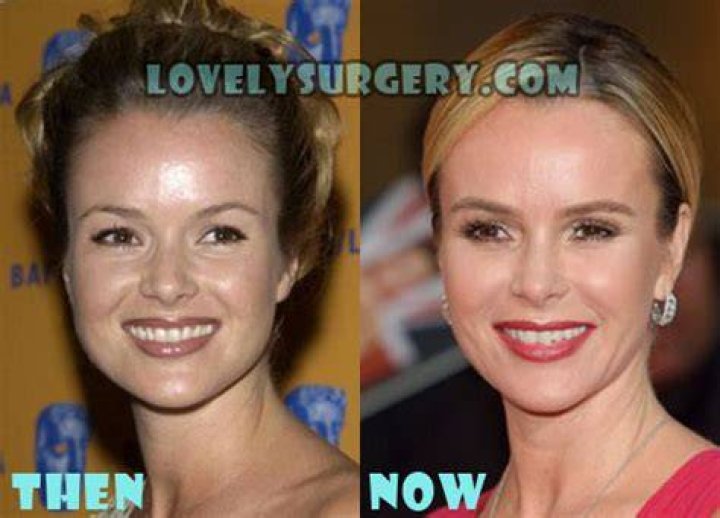 Lovely Surgery Celebrity Before and After Picture