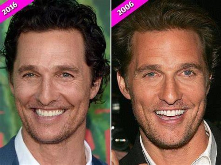 Matthew McConaughey Nose Job Before And After