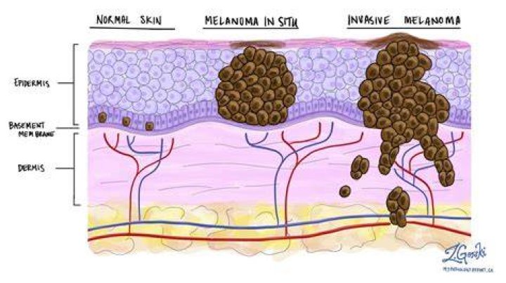 Melanoma DERMBOARD