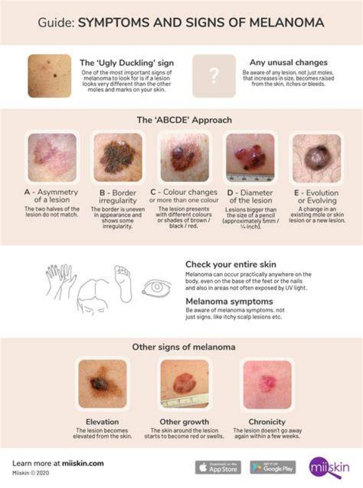 Melanoma Symptoms and Signs Extensive Guide