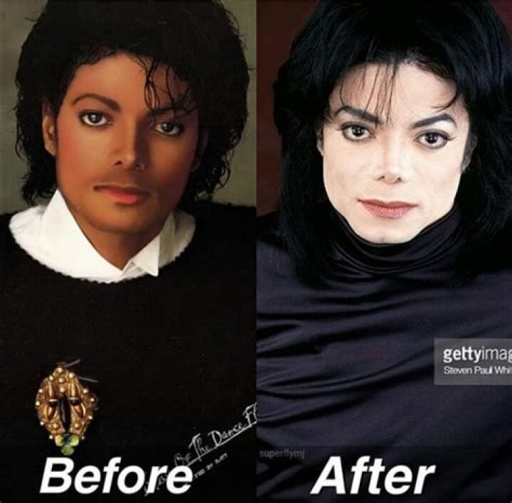Plastick&eacute; operace Michael Jackson CZ
