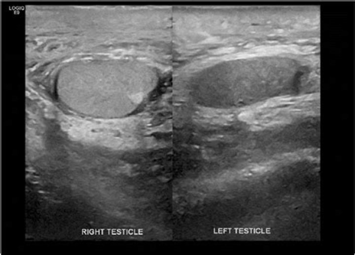 Scrotal Lymphedema