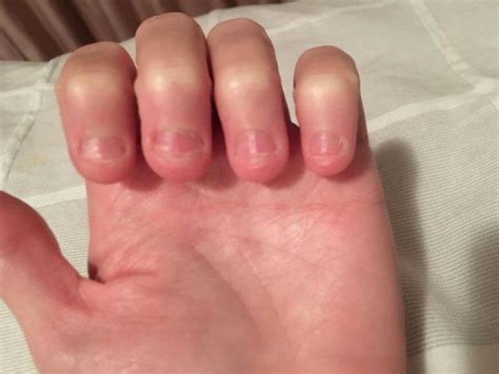 Shortest Fingernails In The World