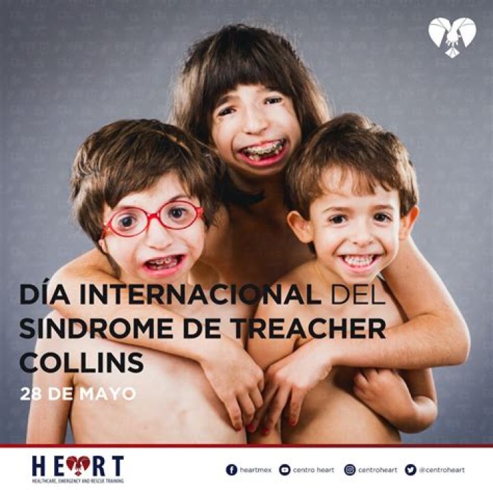 S&iacute;ndrome de Treacher Collins todo sobre la enfermedad que hizo visible