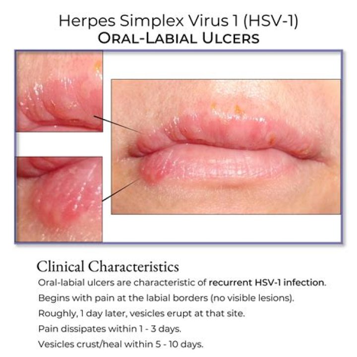 So, Usher Has Herpes &mdash; But So Does 15 Percent of America Allure
