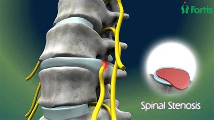 Spinal Stenosis Carolina Regional Orthopedics