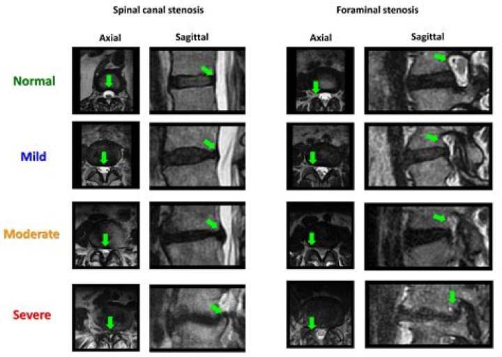 Spinal Stenosis Grades and Treatment Options Premia Spine