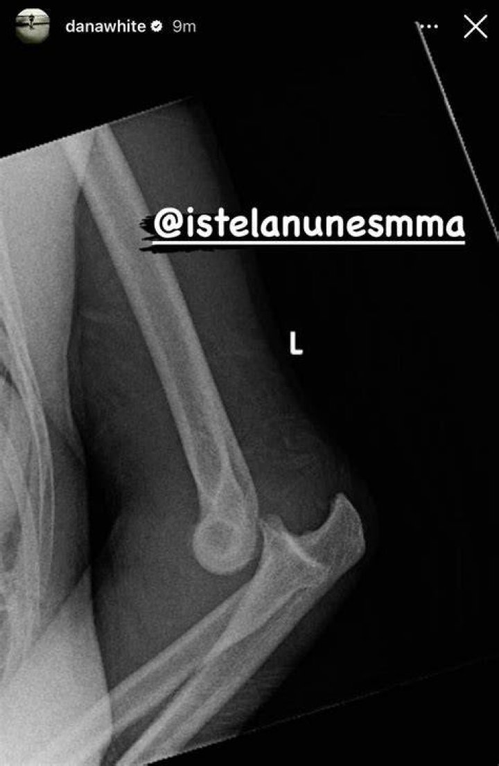 Strawweight Istela Nunes gives update on broken arm