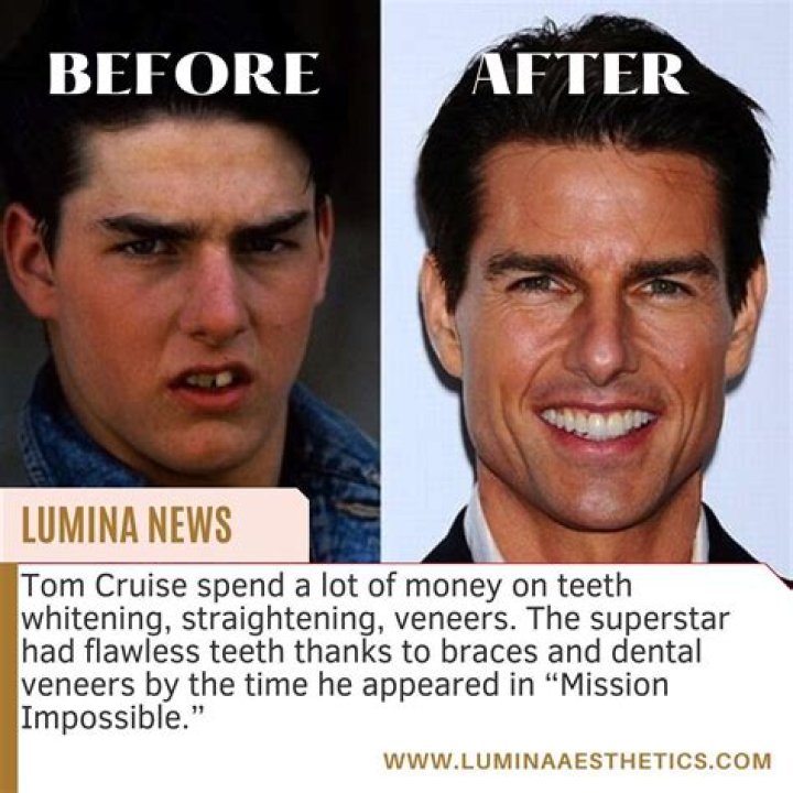 Tom Cruise Teeth / Tom Cruise Transformed His Smile Through Braces And