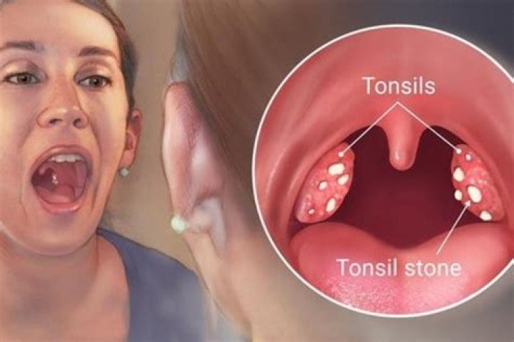 Tonsil Stones Explained Causes, Symptoms, And Treatments