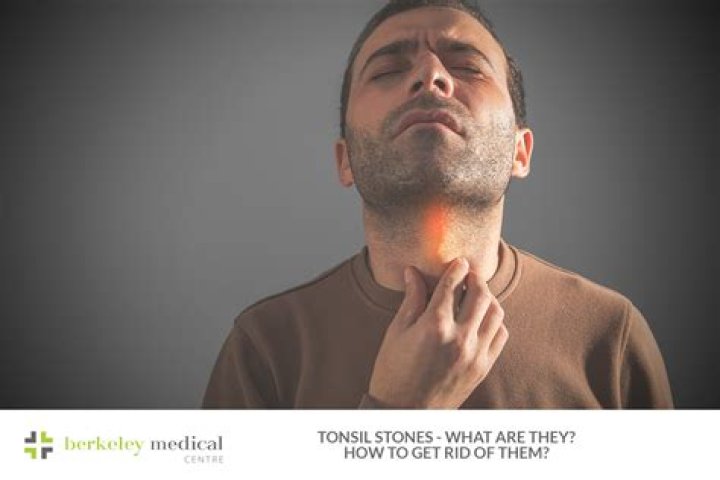 Tonsil Stones What They Are and 6 Ways To Get Rid of Them