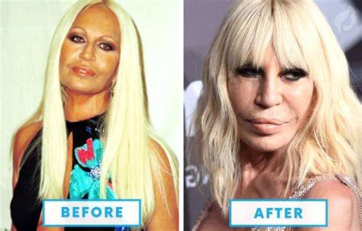 Top 10 Failed Celebrity Plastic Surgeries Mexico Cosmetic Center